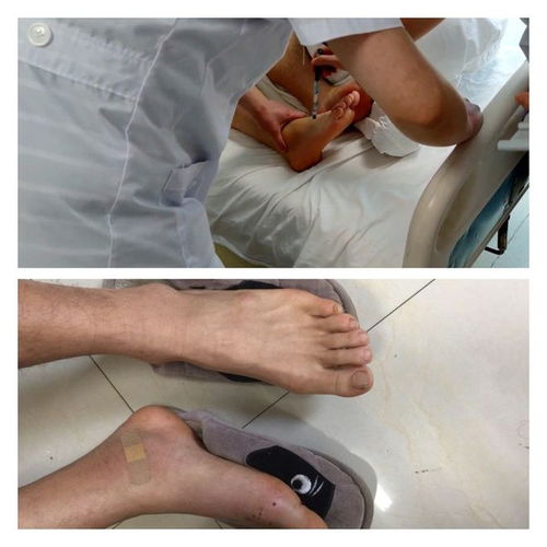 男子双手长满痛风石无法工作